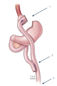 bypass gastrique